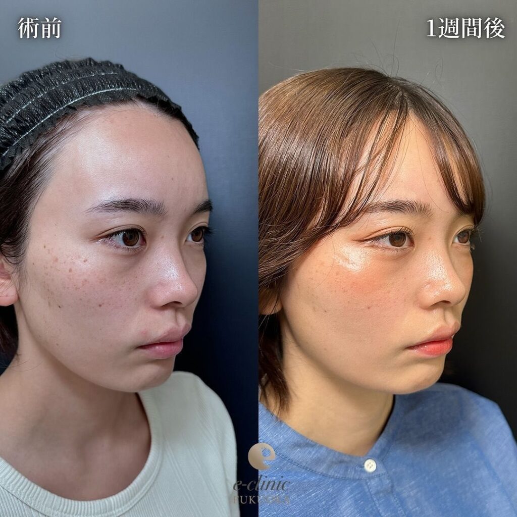 糸リフトの症例写真 (7)