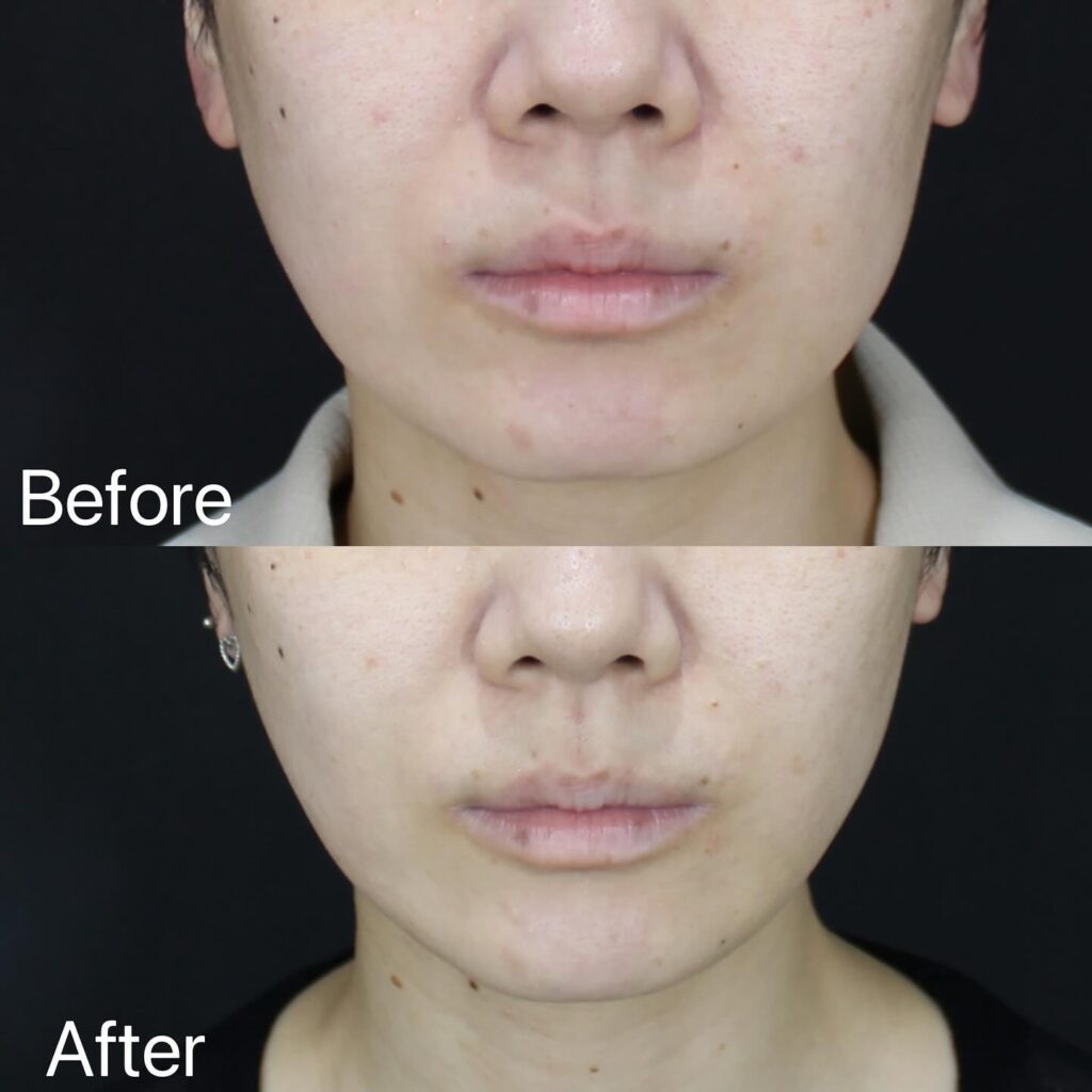 糸リフトの症例写真 (7)