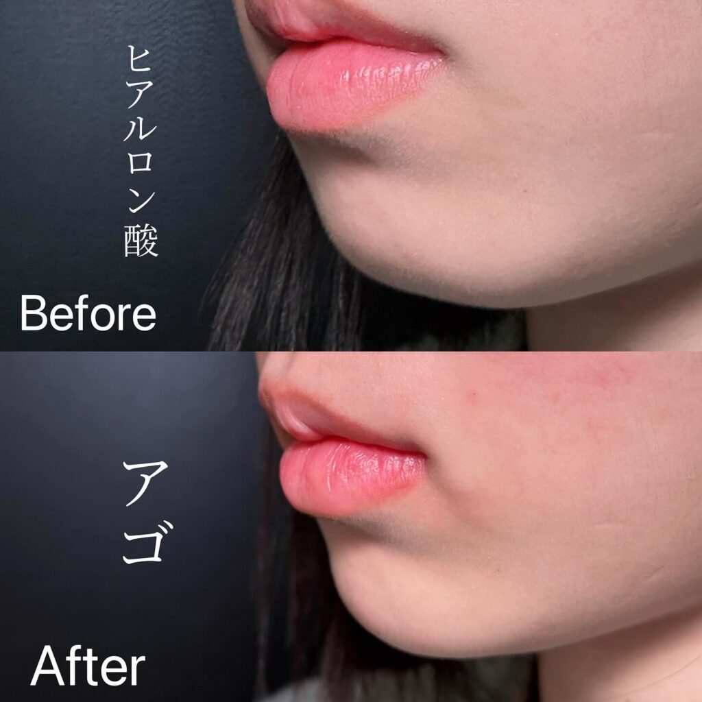 顎のヒアルロン酸の症例写真 (15)