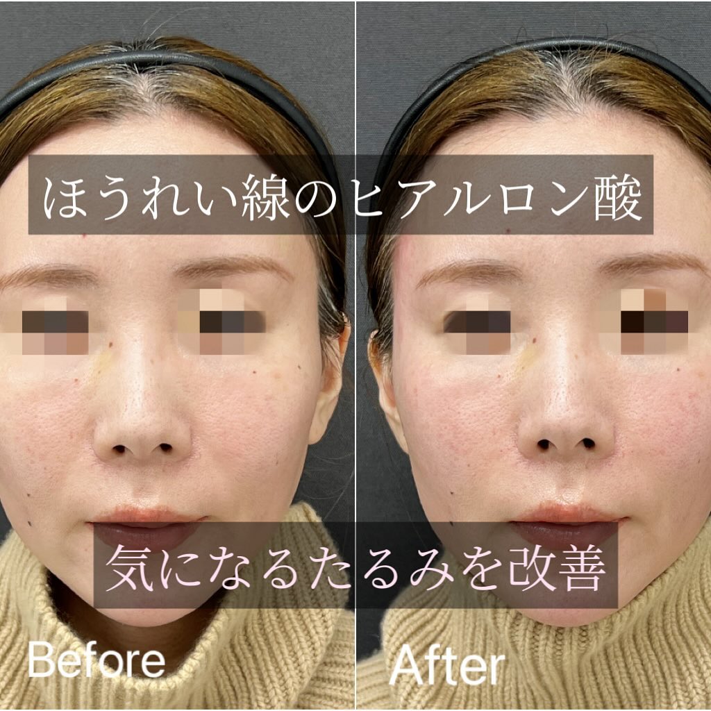 法令線のヒアルロン酸の症例写真 (1)