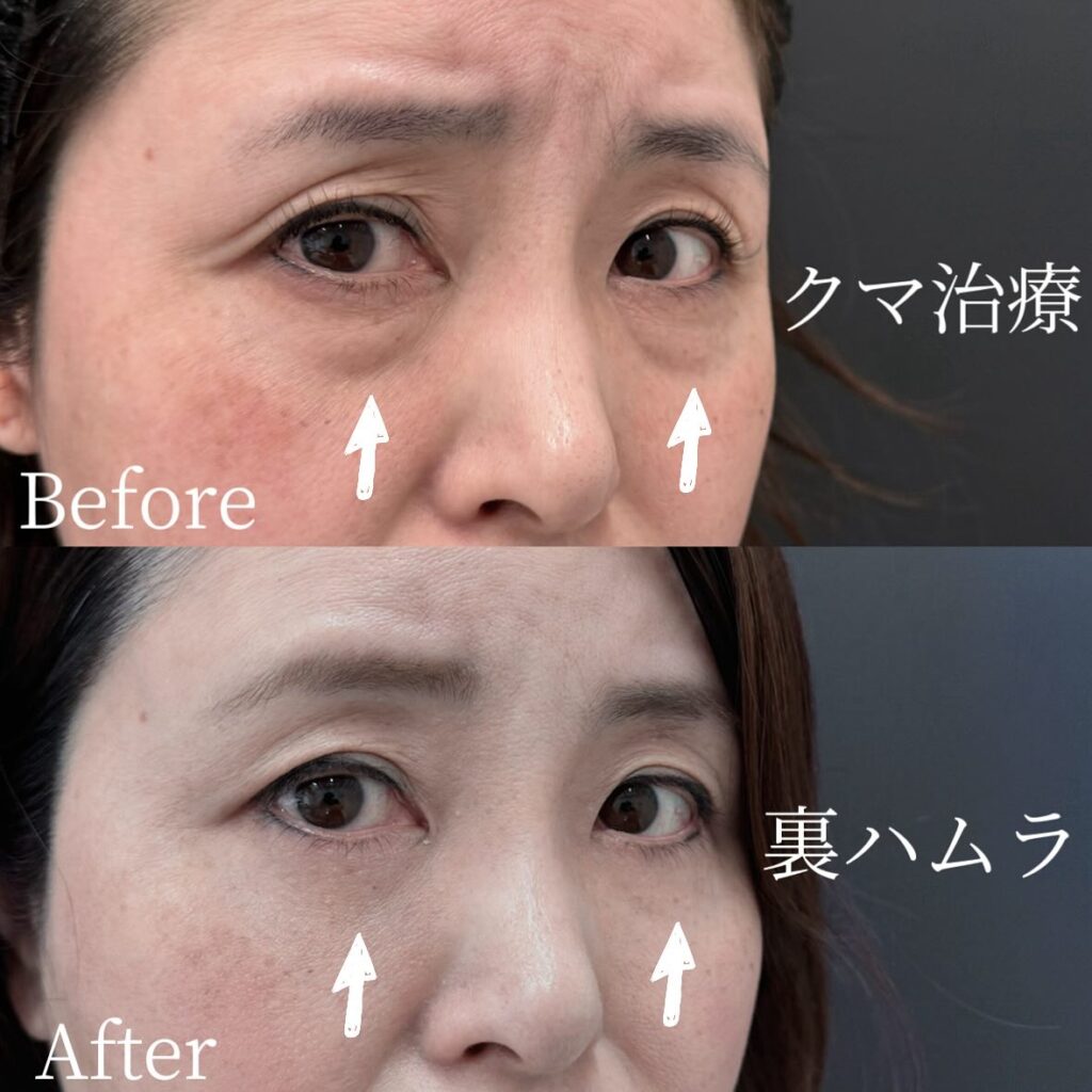 裏ハムラ法の症例写真 (35)