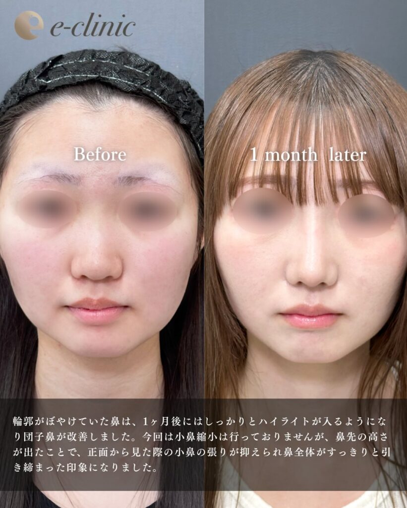 鼻尖形成と軟骨移植とプロテーゼの症例写真 (11)