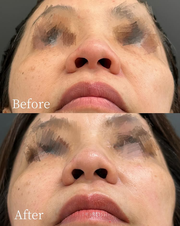 小鼻縮小の症例写真 (3)