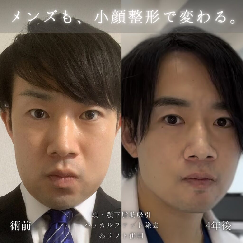 頬と顎下の脂肪吸引とバッカルファットと糸リフトの症例写真