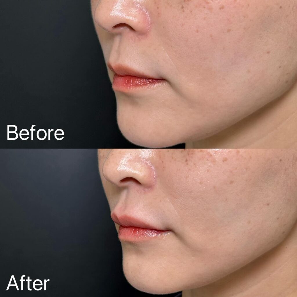 唇のヒアルロン酸の症例写真 (21)