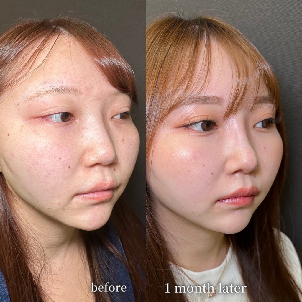 鼻尖形成と軟骨移植とプロテーゼと他院修正の症例写真 (2)