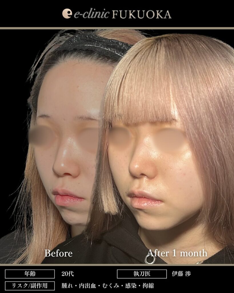 鼻尖形成と軟骨移植と小鼻縮小の症例写真 (19)