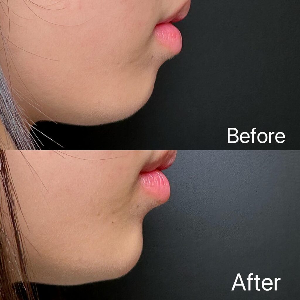 顎のヒアルロン酸の症例写真 (6)