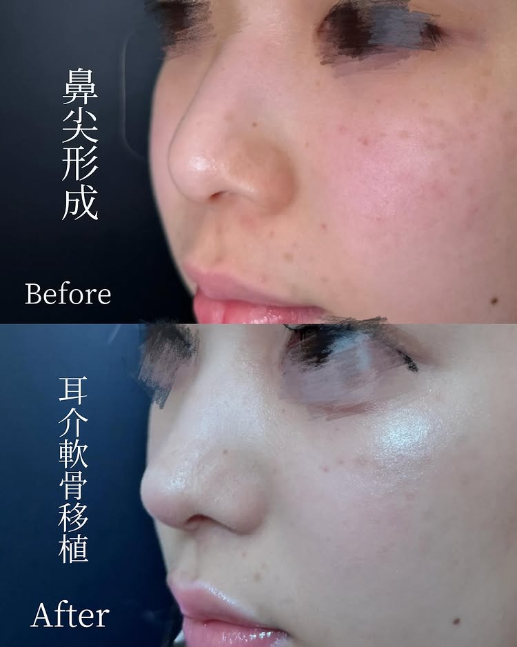 鼻尖形成と耳介軟骨移植の症例写真