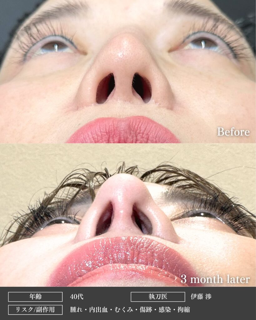 鼻尖部軟骨移植と鼻尖形成とプロテーゼの入れ替えの症例写真 (2)