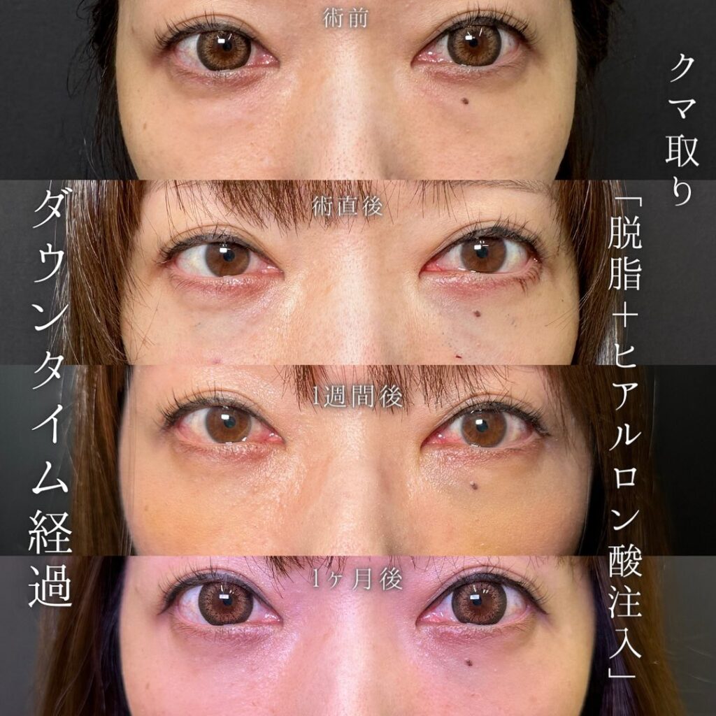 脱脂と目の下のヒアルロン酸の症例写真 (5)