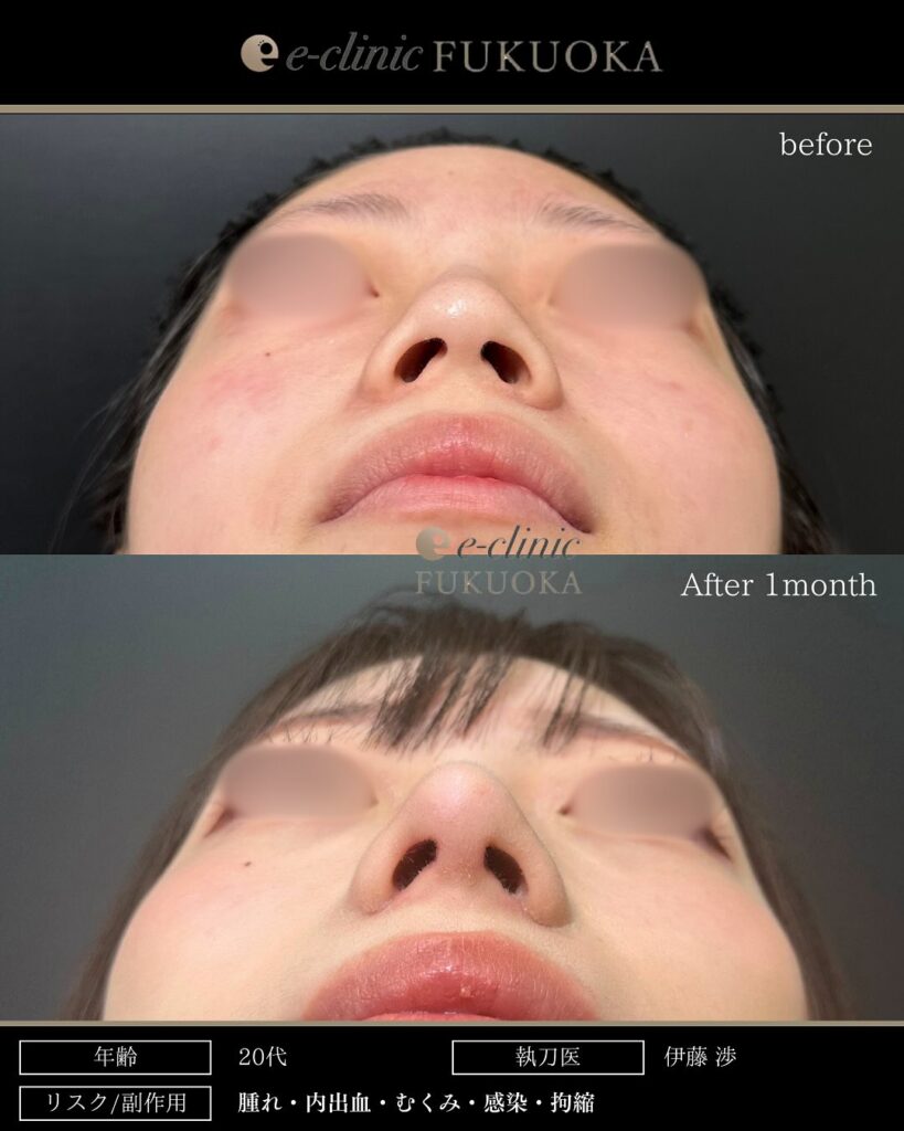 鼻尖形成と耳介軟骨移植と小鼻縮小と鼻柱下降の症例写真 (2)