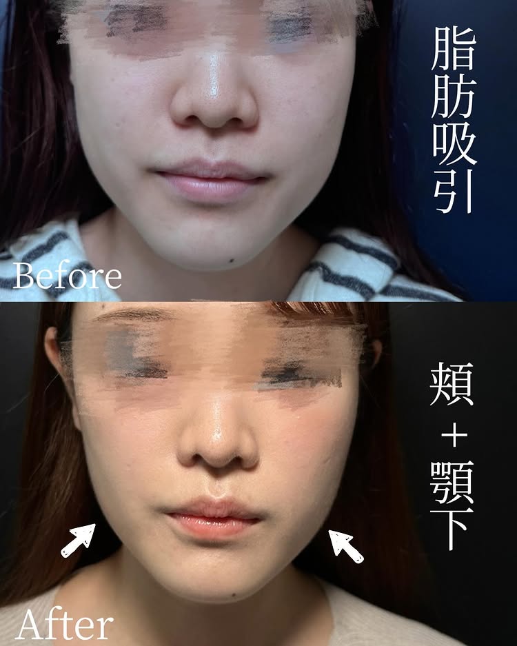 頬と顎下の脂肪吸引の症例写真 (2)