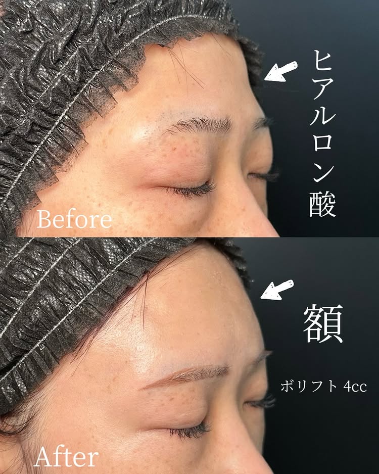 額のヒアルロン酸の症例写真 (1)