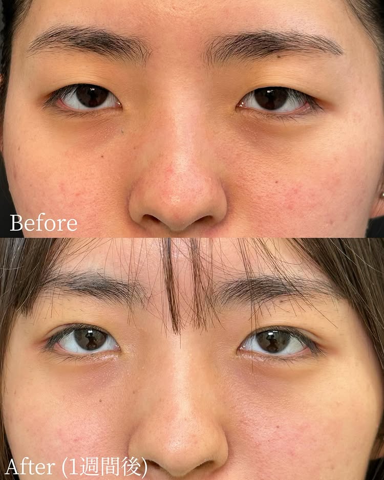 埋没法の症例写真 (8)