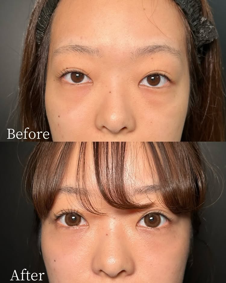 裏ハムラ法の症例写真 (90)