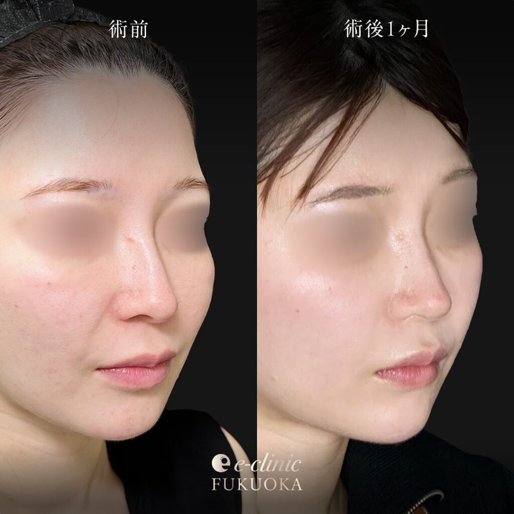 鼻尖形成と軟骨移植の症例写真 (14)