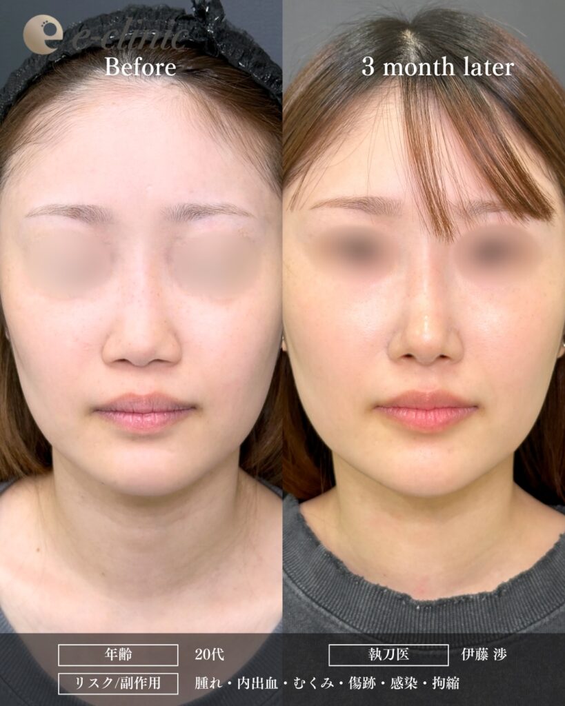 鼻中隔延長と鼻尖形成と軟骨移植とプロテーゼの症例写真 (14)