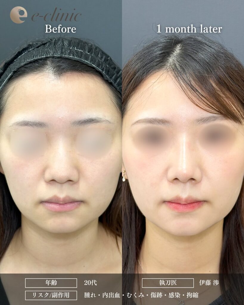 鼻尖形成と軟骨移植とプロテーゼの症例写真 (20)