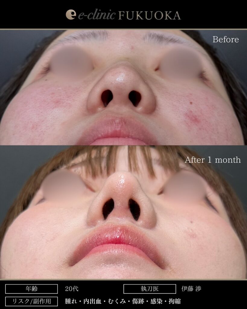 鼻尖形成と耳介軟骨移植と鼻のプロテーゼの症例写真 (2)