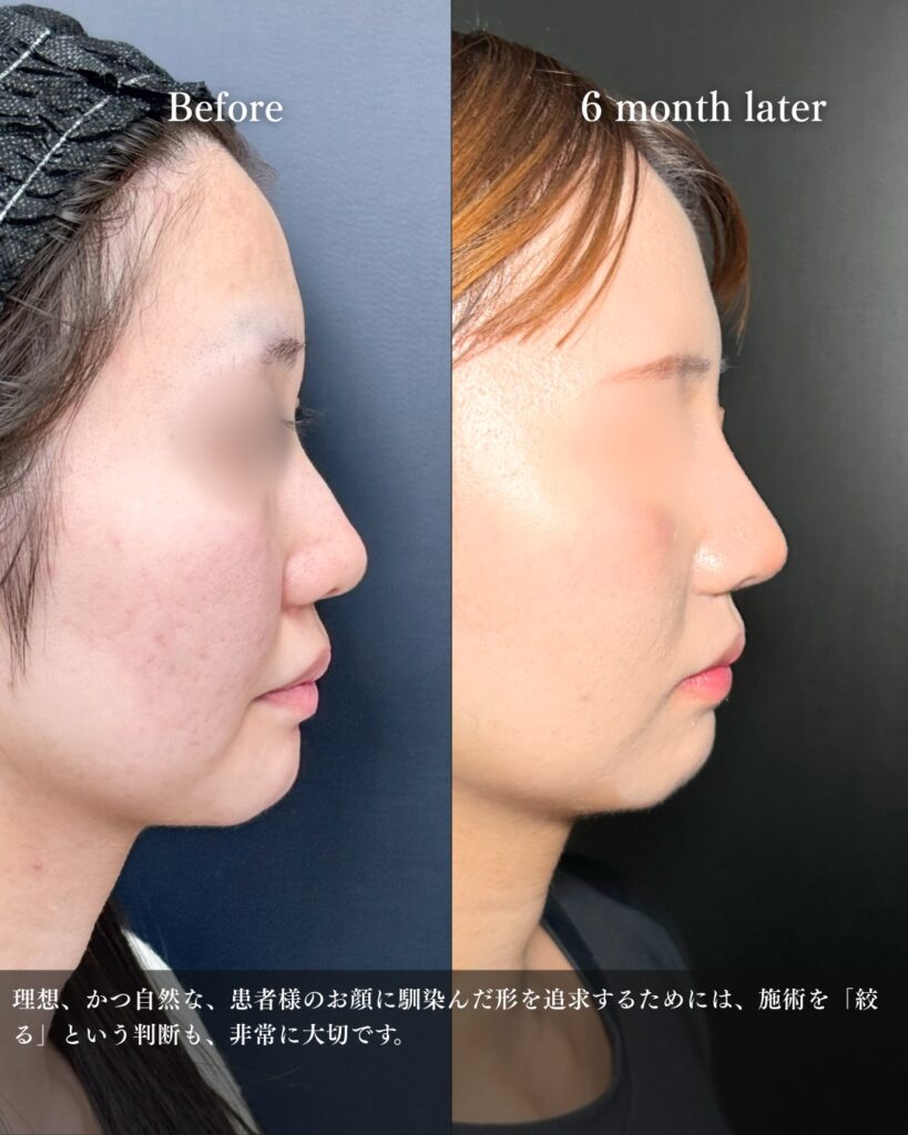 鼻尖形成と耳介軟骨移植とプロテーゼの症例写真 (7)