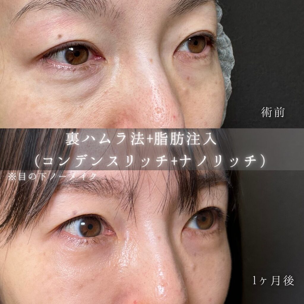 裏ハムラ法と脂肪注入の症例写真 (6)