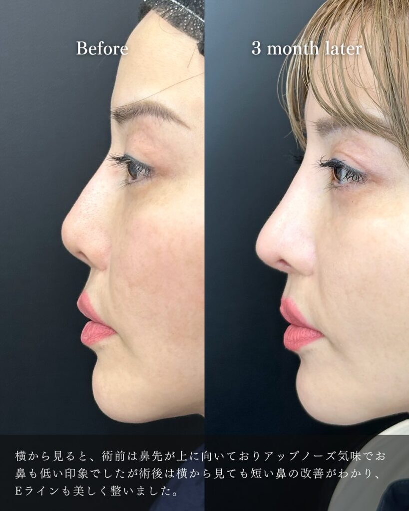 鼻尖部軟骨移植と鼻尖形成とプロテーゼの入れ替えの症例写真 (1)