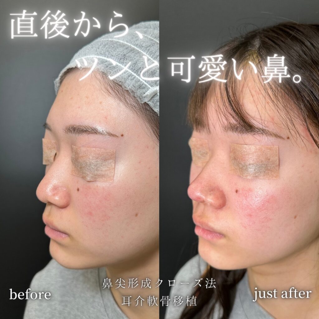 鼻尖形成と軟骨移植の症例写真