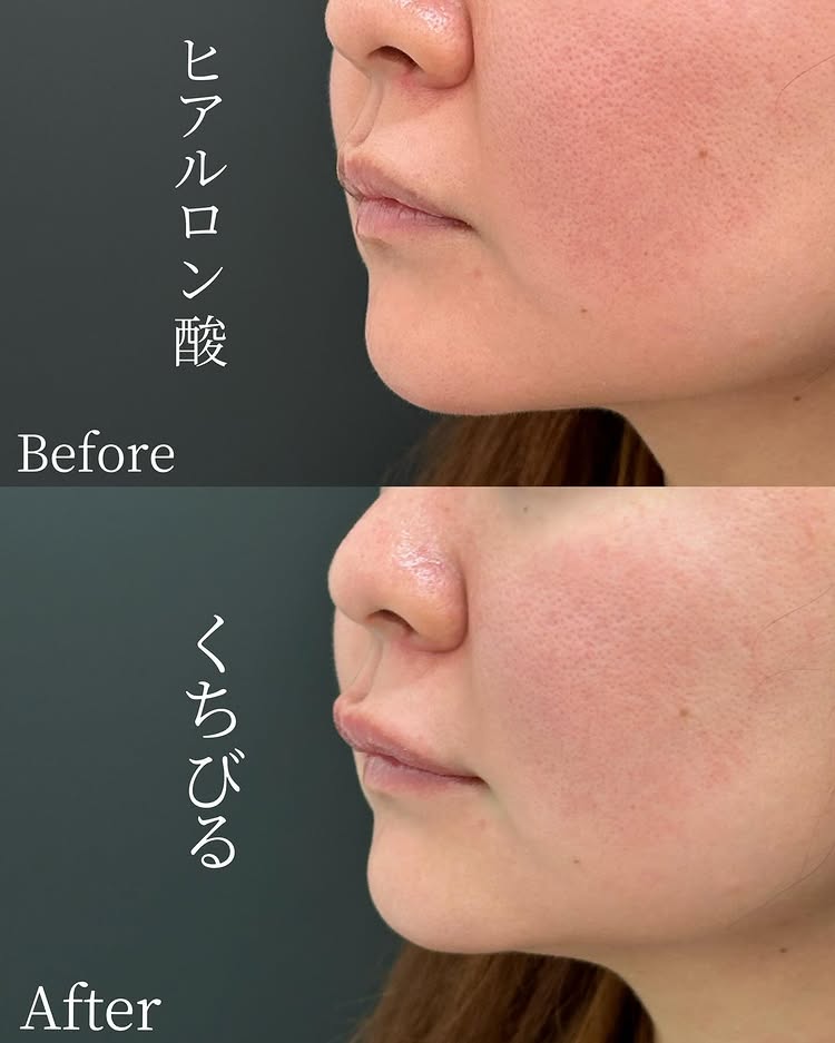 唇のヒアルロン酸の症例写真 (40)