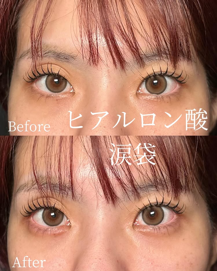 涙袋のヒアルロン酸の症例写真 (12)