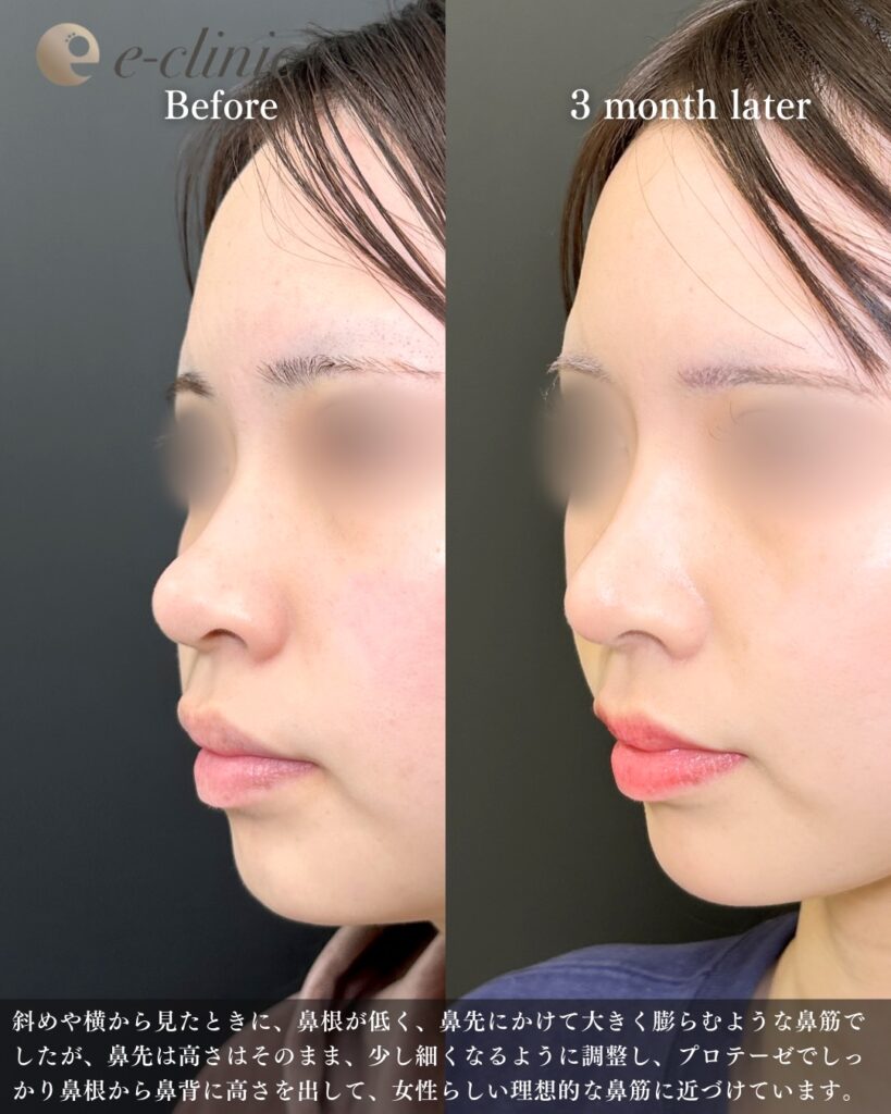 鼻尖形成と軟骨移植とプロテーゼと小鼻縮小の症例写真 (27)