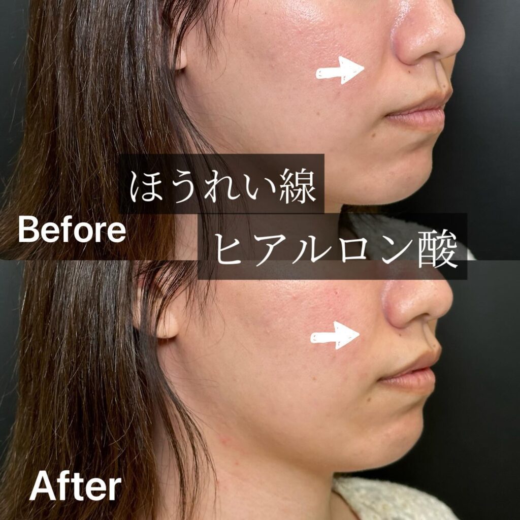 法令線のヒアルロン酸の症例写真 (9)