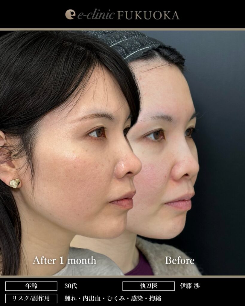 鼻尖形成と軟骨移植と小鼻縮小と裏ハムラ法と脂肪注入の症例写真 (2)