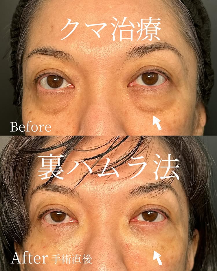 裏ハムラ法の症例写真 (67)