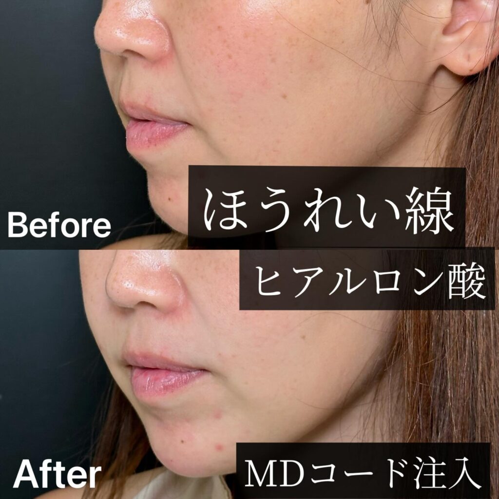 法令線のヒアルロン酸の症例写真 (11)