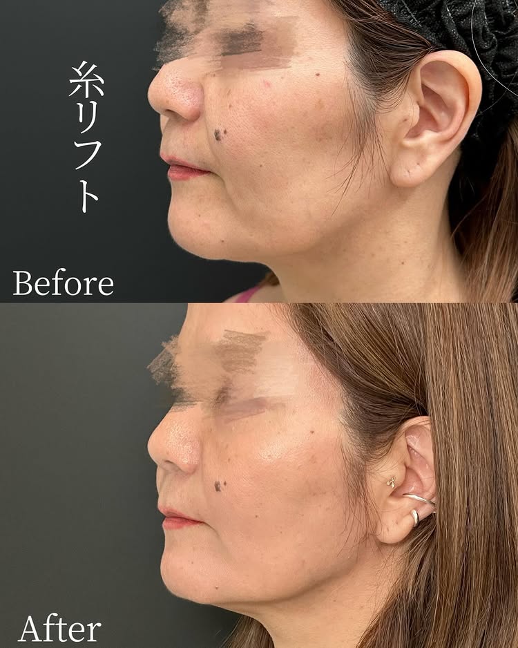 糸リフトの症例写真 (40)