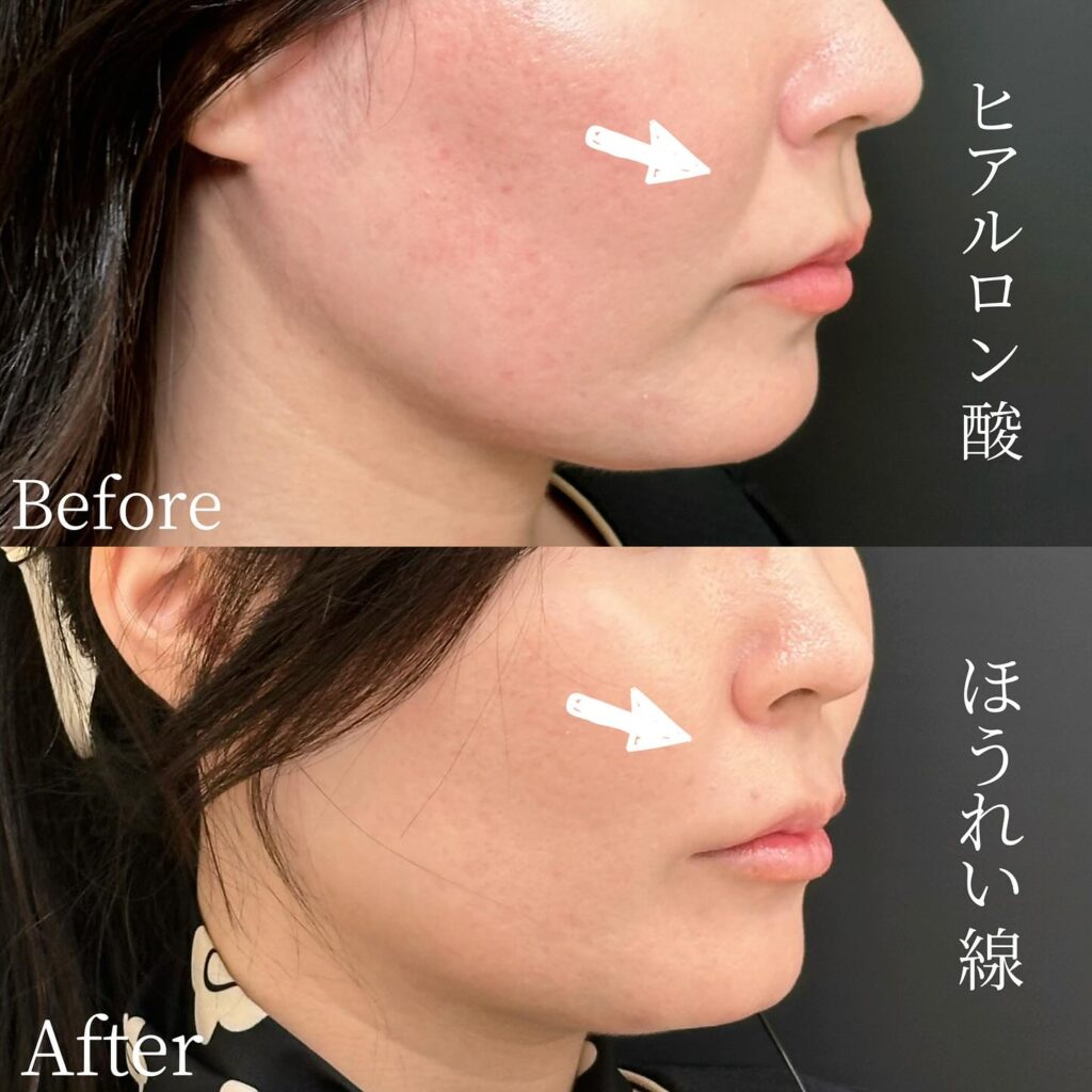 法令線のヒアルロン酸の症例写真 (20)