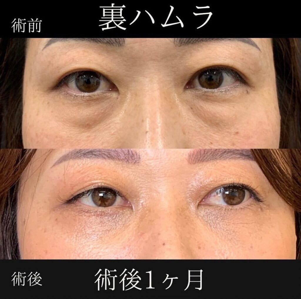 裏ハムラ法の症例写真 (16)