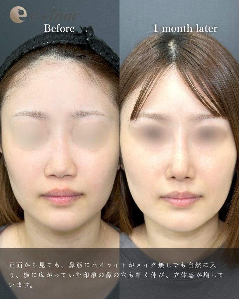 鼻中隔延長と鼻尖形成と軟骨移植とプロテーゼの症例写真 (7)