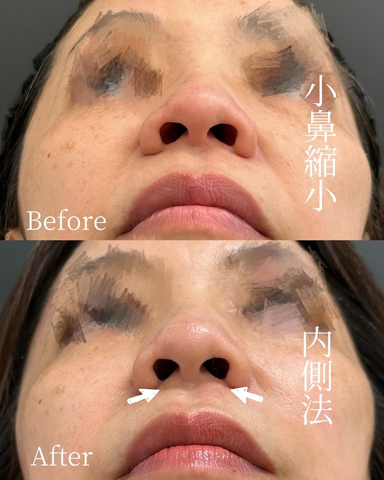 小鼻縮小の症例写真 (2)