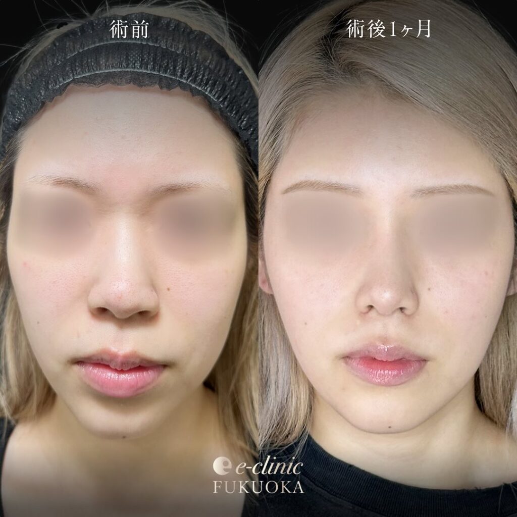 鼻尖形成と軟骨移植とプロテーゼと小鼻縮小の症例写真 (9)