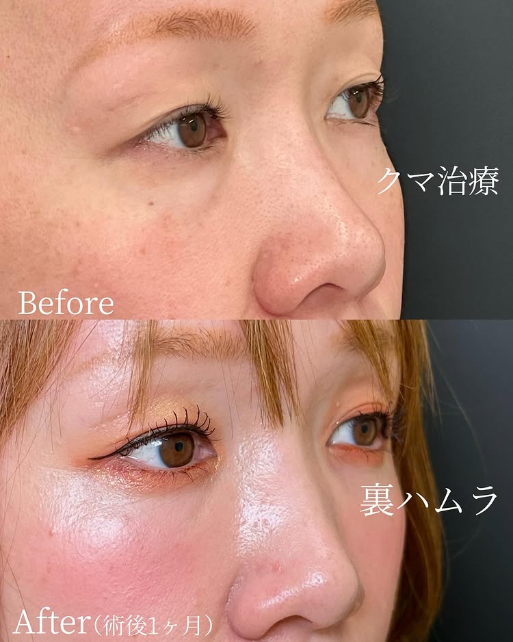 裏ハムラ法の症例写真 (51)