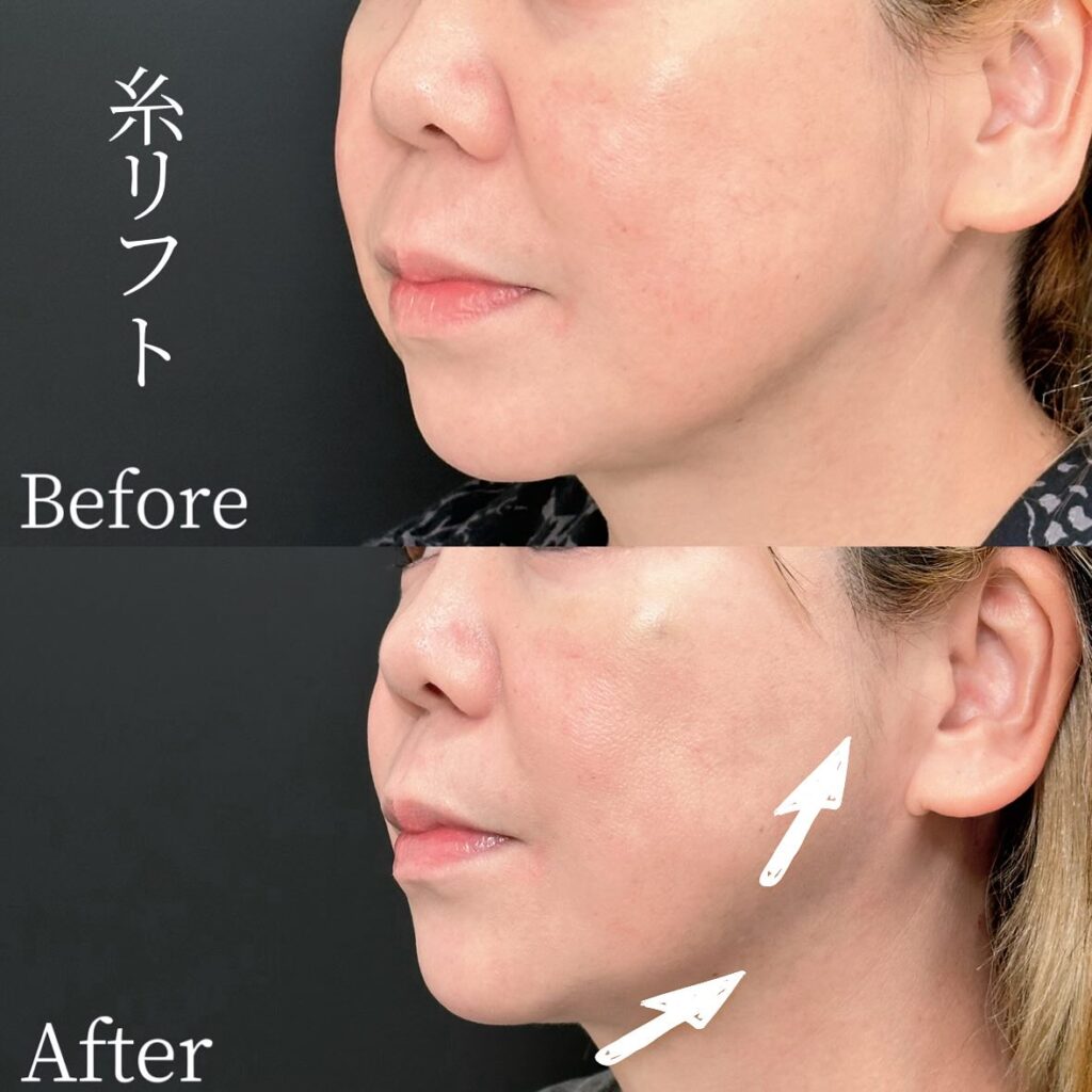 糸リフトの症例写真 (27)