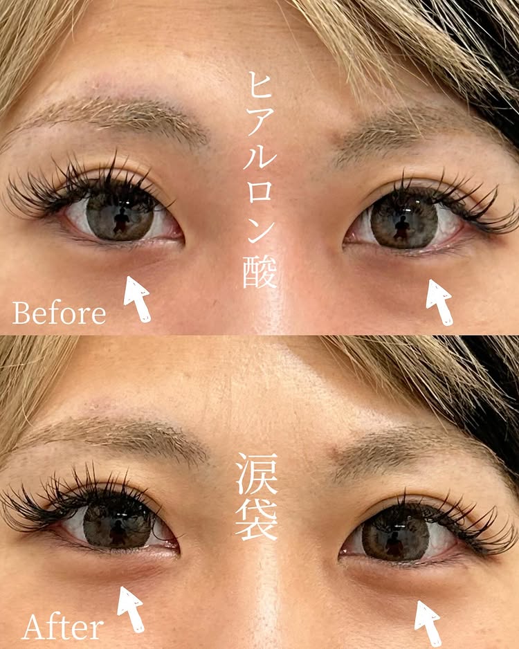 涙袋のヒアルロン酸の症例写真