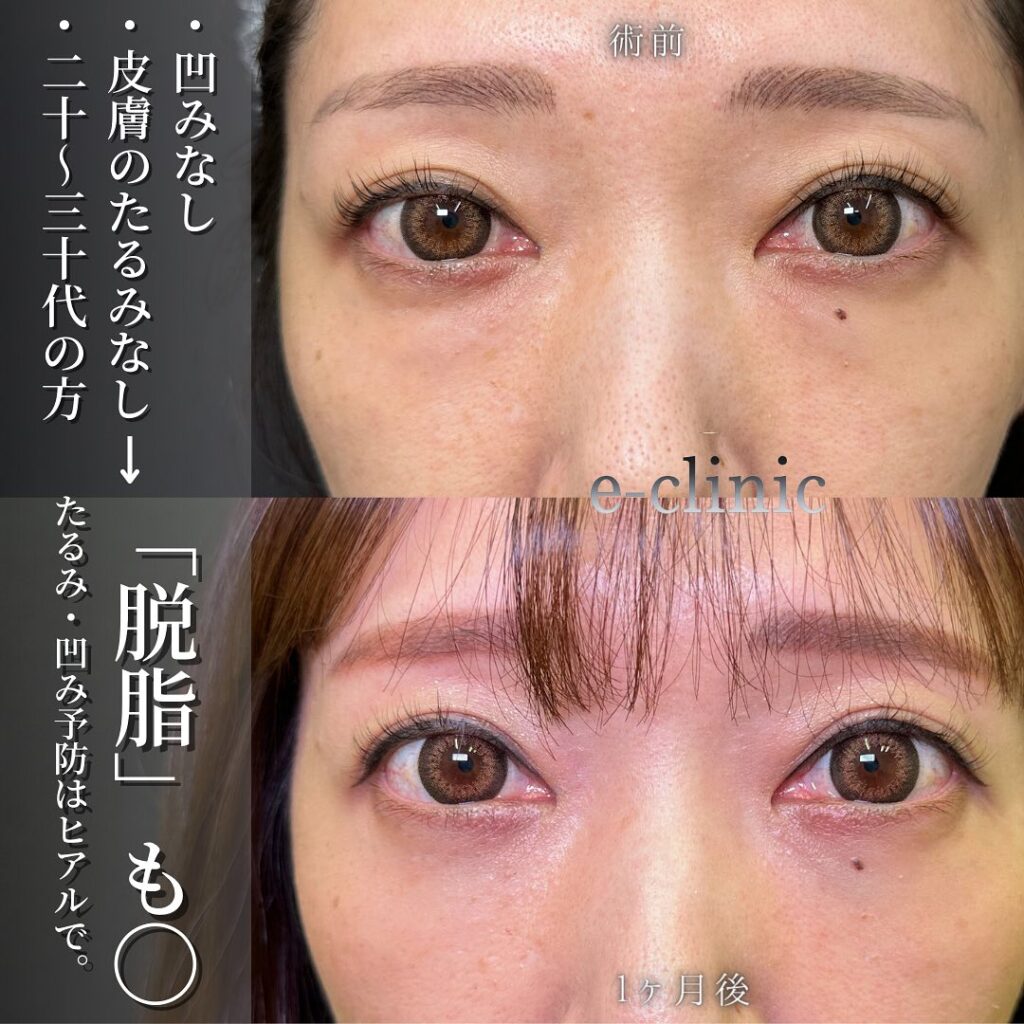 脱脂と目の下のヒアルロン酸の症例写真 (1)