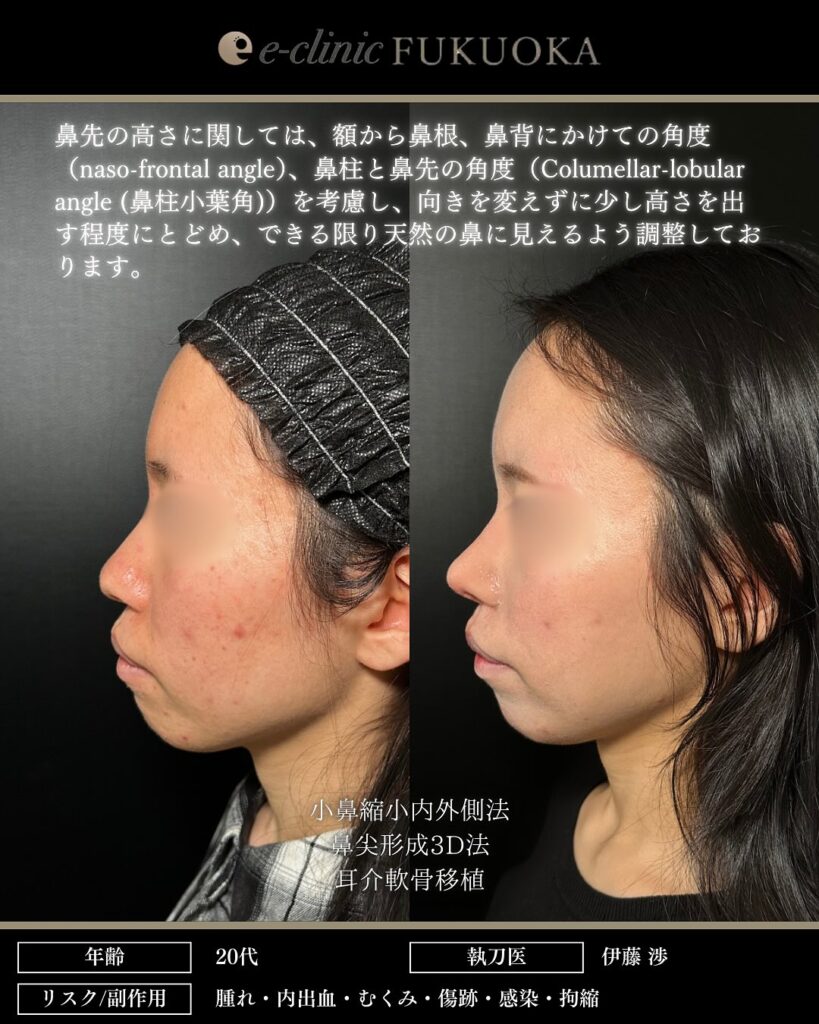 鼻尖形成と軟骨移植と小鼻縮小の症例写真 (21)