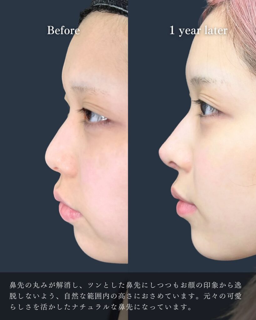 鼻尖形成と軟骨移植と小鼻縮小の症例写真 (34)