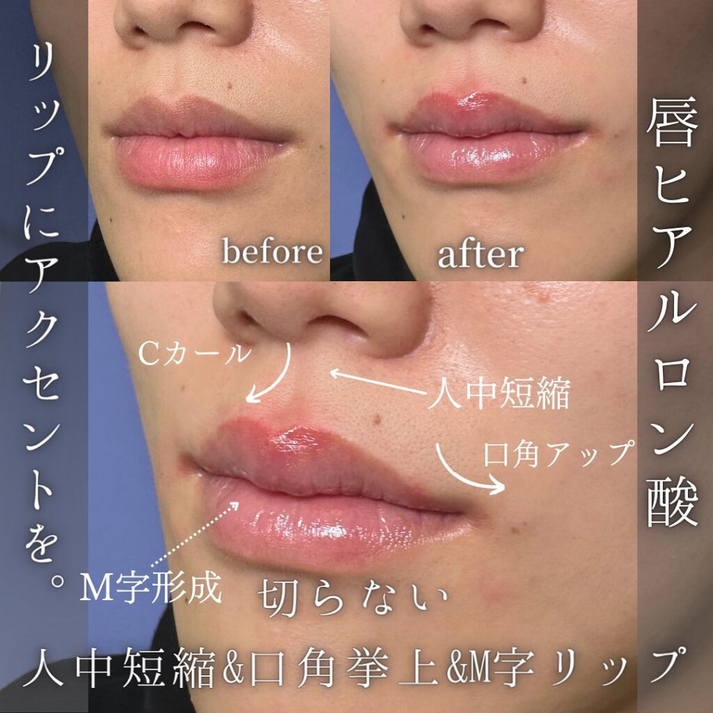 唇のヒアルロン酸の症例写真 (12)