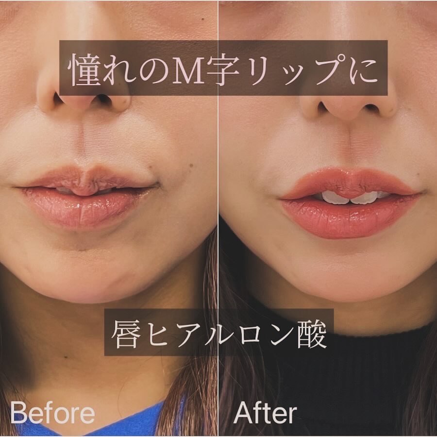 唇のヒアルロン酸の症例写真 (12)