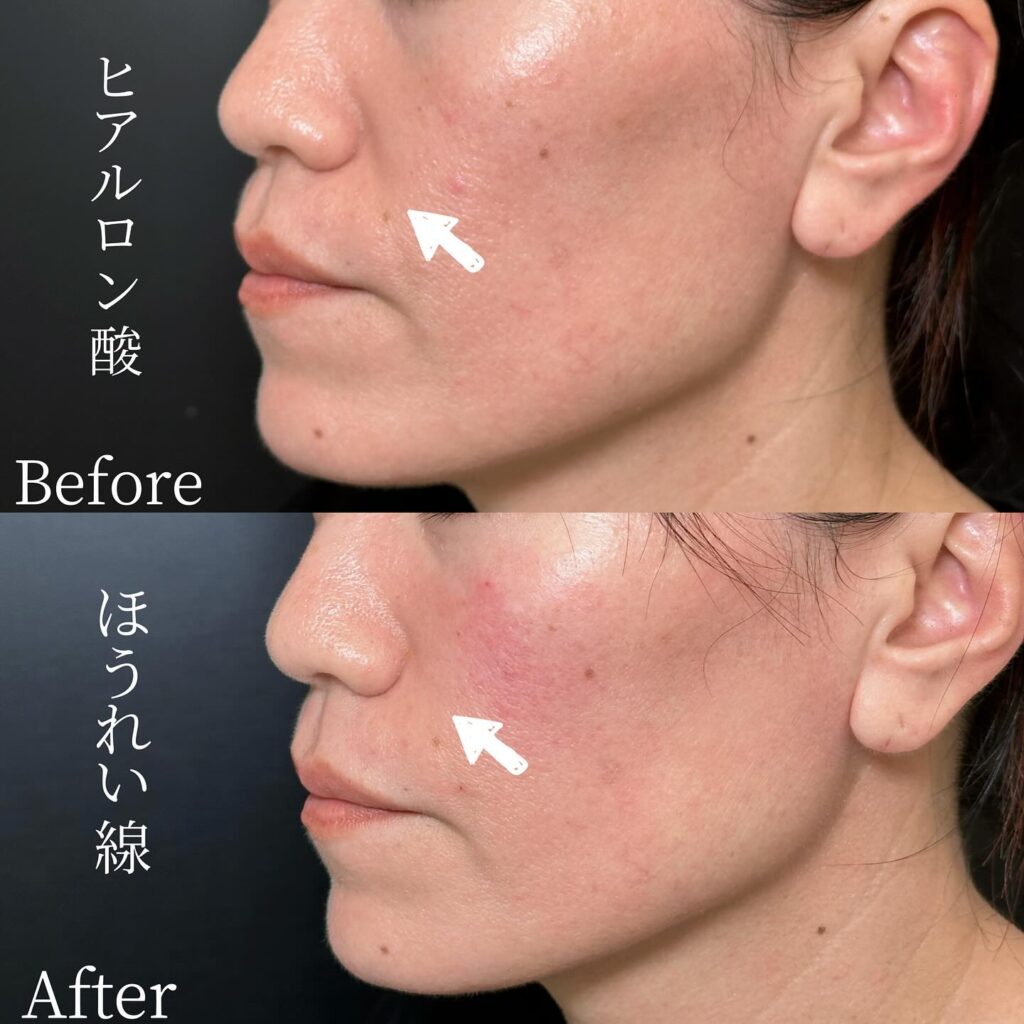 法令線のヒアルロン酸 (2)